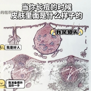 皮肤爆痘留印又留坑的真相